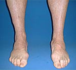 After the use of CORRECTIVE ORTHOTIC DEVICE